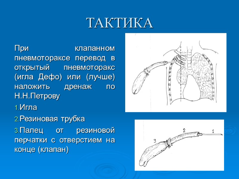 ТАКТИКА При клапанном пневмотораксе перевод в открытый пневмоторакс (игла Дефо) или (лучше) наложить дренаж